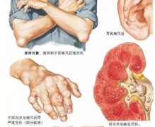 痛风石是痛风不及时治疗拖出来的吗？