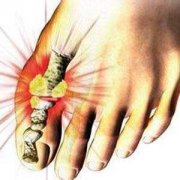 成都痛风病专家：痛风具体有哪些症状?