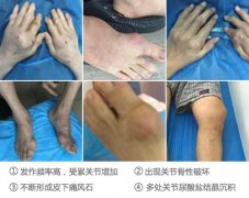【疾病解析】痛风不同时期的症状表现