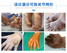 根本性防治痛风，须重视的四大致病因素