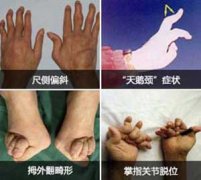 了解类风湿性关节炎症状，科学有效防治