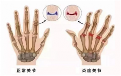 类风湿因子正常值是多少？类风湿与类风湿因子又是什么