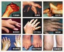 找准类风湿性关节炎病因，针对性选择治疗