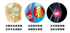 西部痛风风湿医院治疗类风湿花费少，效果好！