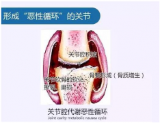 成都治疗类风湿性关节炎的费用